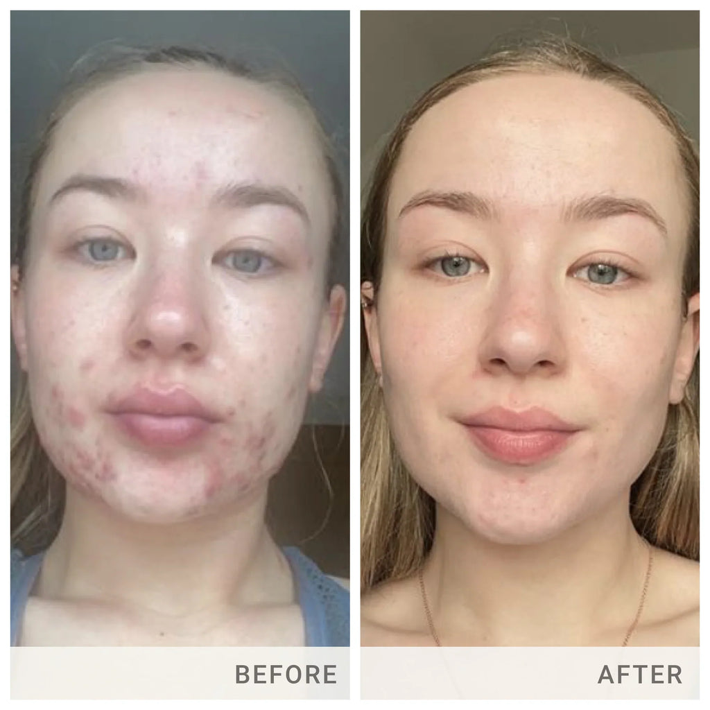 Skin Accumax